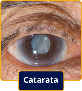Catarata