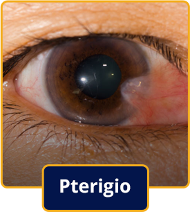 Pterigio