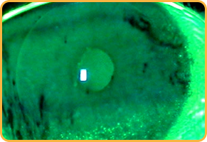 Ojo verde